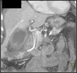 Acute Cholecystitis - CTisus CT Scan