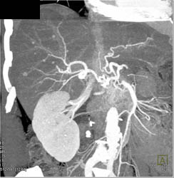 Liver Mets- Small Vascular Mass - CTisus CT Scan