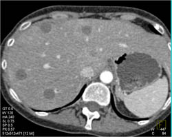 Liver Abscesses Look Like Metastases - CTisus CT Scan