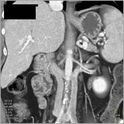 Duplicated IVC - CTisus CT Scan