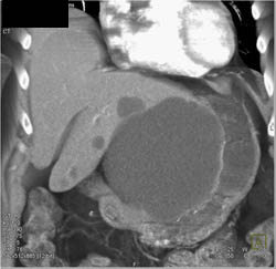 Huge Cyst Off Left Lobe of Liver Did Give Symptoms - CTisus CT Scan