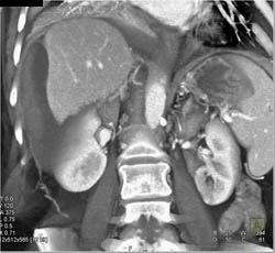 Subcapsular Bleed With Stent - CTisus CT Scan