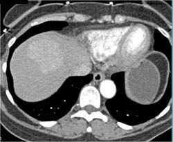 Focal Nodular Hyperplasia (FNH)- Classic - CTisus CT Scan