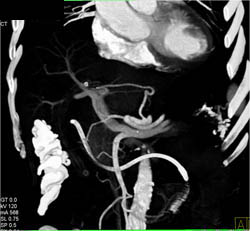 Small Vascular Liver Metastases From Islet Cell - CTisus CT Scan