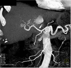 Cirrhosis With Abnormal Vascularity - CTisus CT Scan