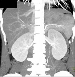 Subtle Hepatocellular Carcinoma (HCC) on CTA Only - CTisus CT Scan