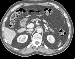 Portal Vein Aneurysm - CTisus CT Scan