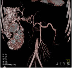 Hepatoma Following Tace - CTisus CT Scan