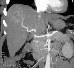 Hepatoma on CTA - CTisus CT Scan