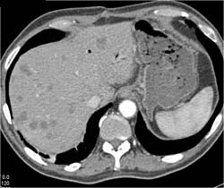 Liver Metastases From Pancreatic Carcinoma - CTisus CT Scan