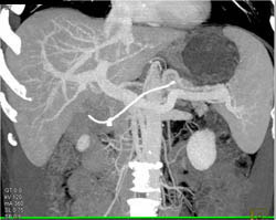 See How MIP Does Not Display Lesions - CTisus CT Scan