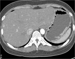 Tiny Metastases From An Islet Cell Tumor - CTisus CT Scan