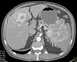 Large Islet Cell With Liver Metastases - CTisus CT Scan