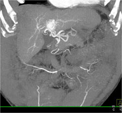 Vascular Malformation and Shunting - CTisus CT Scan