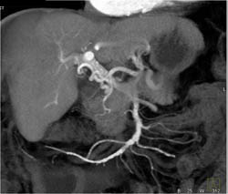 Cirrhosis - CTisus CT Scan