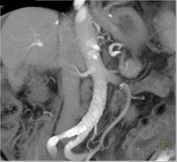 Cirrhosis - CTisus CT Scan