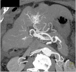 Cirrhosis - CTisus CT Scan