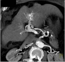 Cirrhosis - CTisus CT Scan