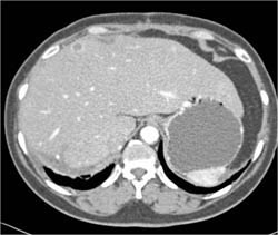 Liver Metastases From Vascular Renal Cell Carcinoma - CTisus CT Scan