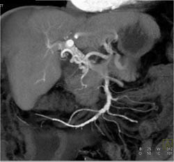 Cirrhosis - CTisus CT Scan