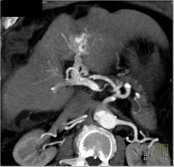 Cirrhosis - CTisus CT Scan