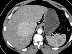 Focal Nodular Hyperplasia (FNH) - CTisus CT Scan