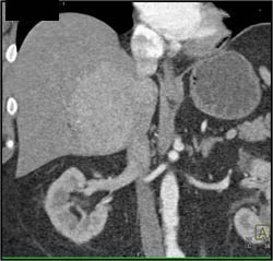 Focal Nodular Hyperplasia (FNH) - CTisus CT Scan