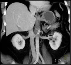 Focal Nodular Hyperplasia (FNH) - CTisus CT Scan