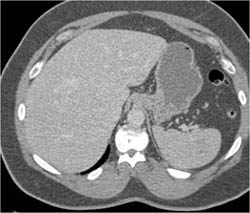 Focal Nodular Hyperplasia (FNH) - CTisus CT Scan