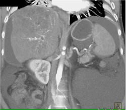 Hepatoma With Neovascularity - CTisus CT Scan