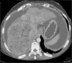 Hepatoma With Neovascularity - CTisus CT Scan