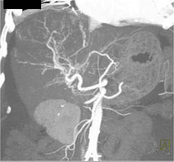 Hepatoma With Neovascularity - CTisus CT Scan