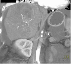 Hepatoma With Neovascularity - CTisus CT Scan