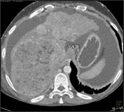 Hepatoma With Neovascularity - CTisus CT Scan