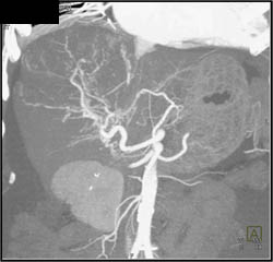 Hepatoma With Neovascularity - CTisus CT Scan