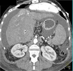 Hepatoma With Neovascularity - CTisus CT Scan