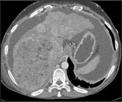 Hepatoma With Neovascularity - CTisus CT Scan