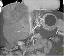 Hepatoma With Neovascularity - CTisus CT Scan