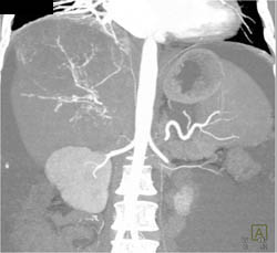 Hepatoma With Neovascularity - CTisus CT Scan