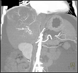 Hepatoma With Neovascularity - CTisus CT Scan