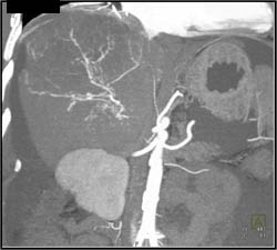 Hepatoma With Neovascularity - CTisus CT Scan