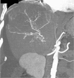 Hepatoma With Neovascularity - CTisus CT Scan