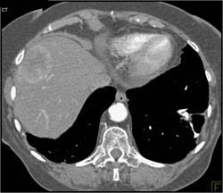 Hepatoma Develops in A Cirrhotic Liver - CTisus CT Scan