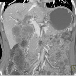 Cholangiocarcinoma - CTisus CT Scan