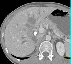 Cholangiocarcinoma - CTisus CT Scan