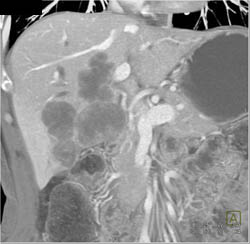 Cholangiocarcinoma - CTisus CT Scan