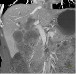 Cholangiocarcinoma - CTisus CT Scan