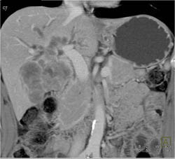 Cholangiocarcinoma - CTisus CT Scan