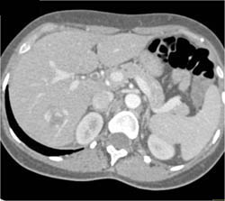 Hemangioma - CTisus CT Scan