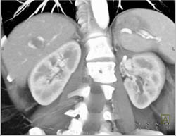 Hemangioma - CTisus CT Scan